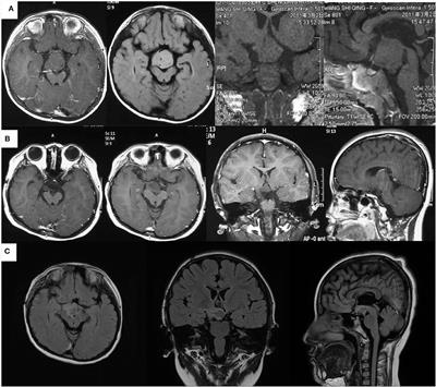 Frontiers | Distinguishing Dependent-Stage Secondary Epileptogenesis In ...